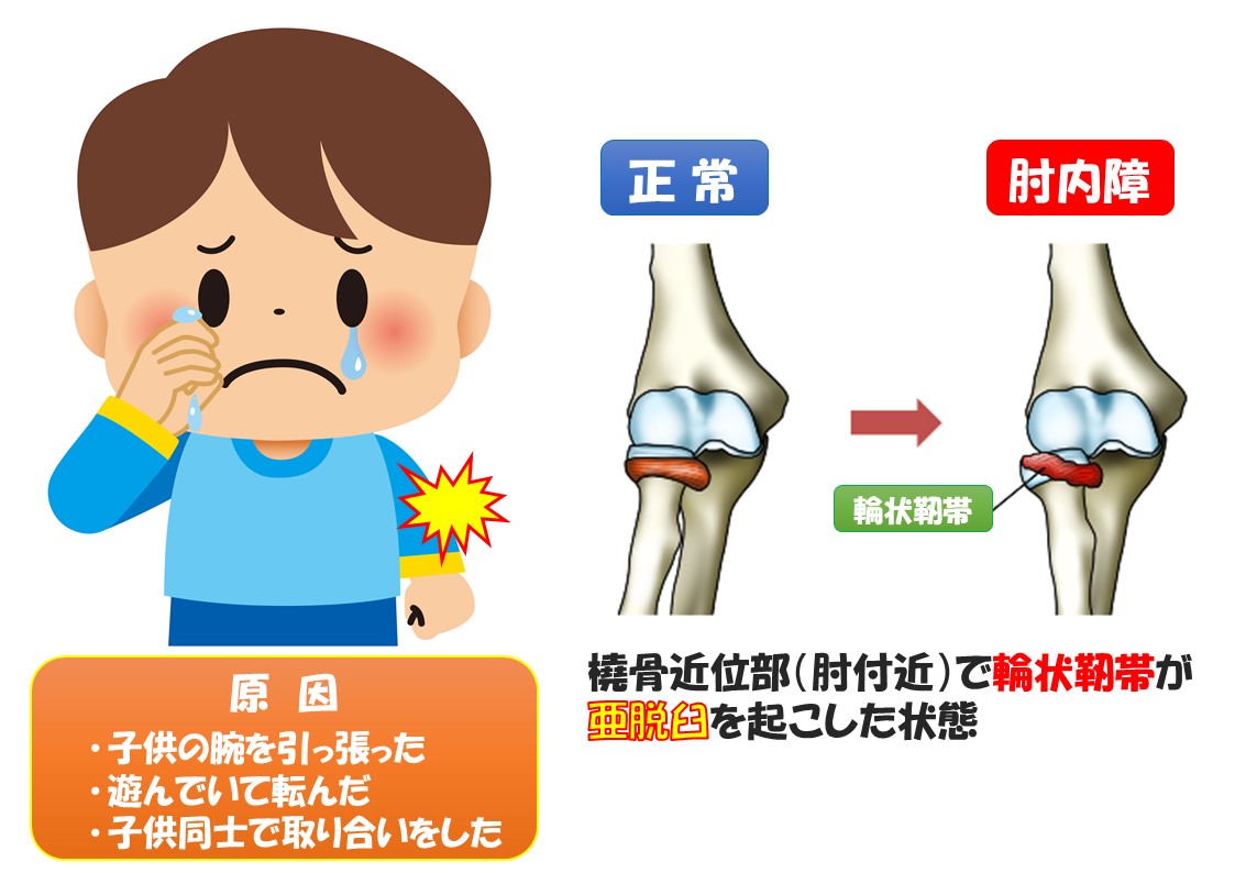 子供の肘が抜ける（肘内障） | Body care HAReRU